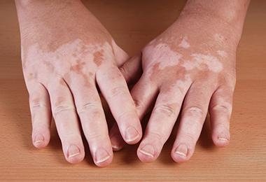 skin-disorders