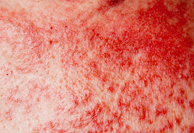 skin cancer
